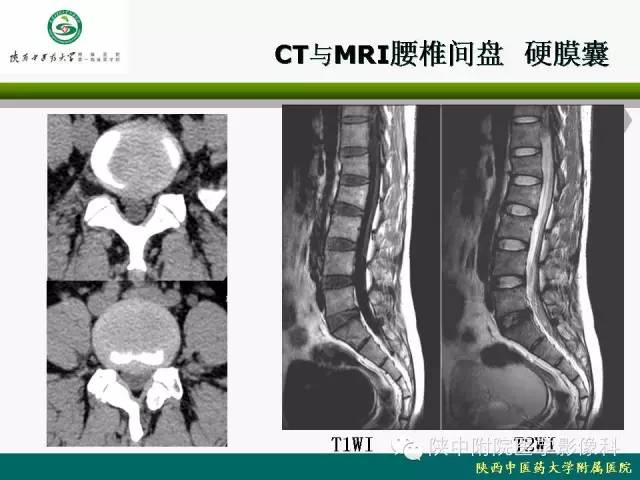 【PPT】脊柱肿瘤的影像学诊断