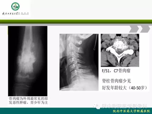 【PPT】脊柱肿瘤的影像学诊断