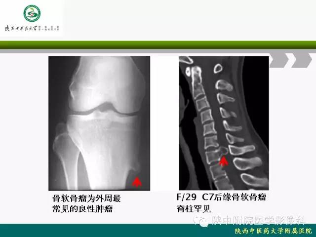【PPT】脊柱肿瘤的影像学诊断