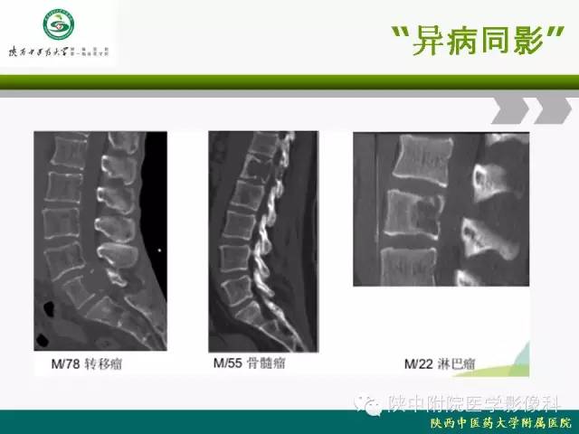 【PPT】脊柱肿瘤的影像学诊断