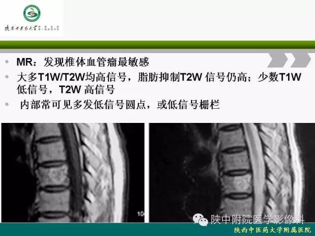 【PPT】脊柱肿瘤的影像学诊断