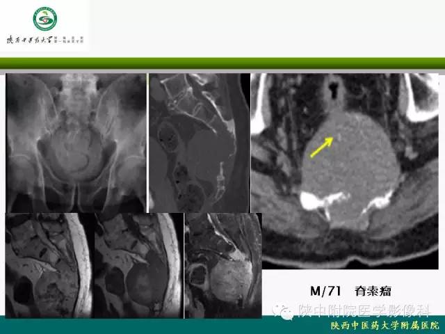 【PPT】脊柱肿瘤的影像学诊断