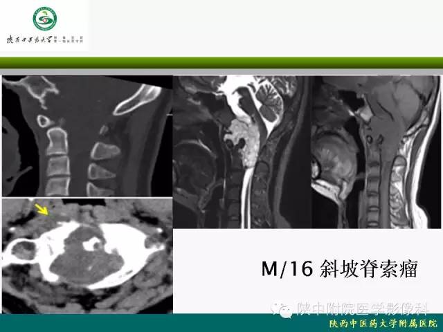 【PPT】脊柱肿瘤的影像学诊断