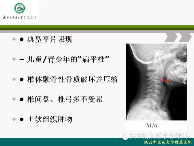 【PPT】脊柱肿瘤的影像学诊断