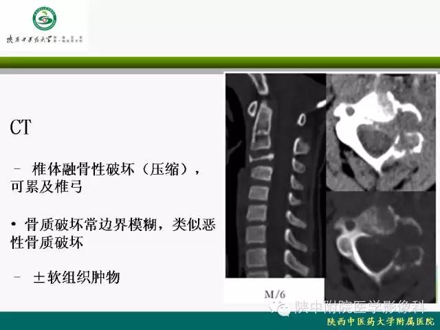 【PPT】脊柱肿瘤的影像学诊断