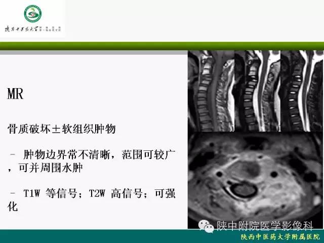 【PPT】脊柱肿瘤的影像学诊断