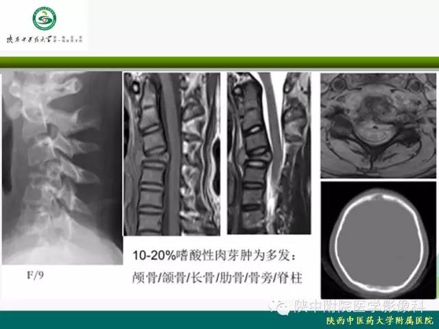 【PPT】脊柱肿瘤的影像学诊断