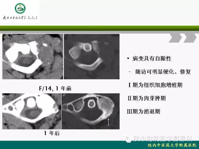 【PPT】脊柱肿瘤的影像学诊断