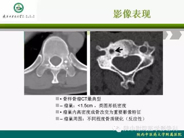 【PPT】脊柱肿瘤的影像学诊断