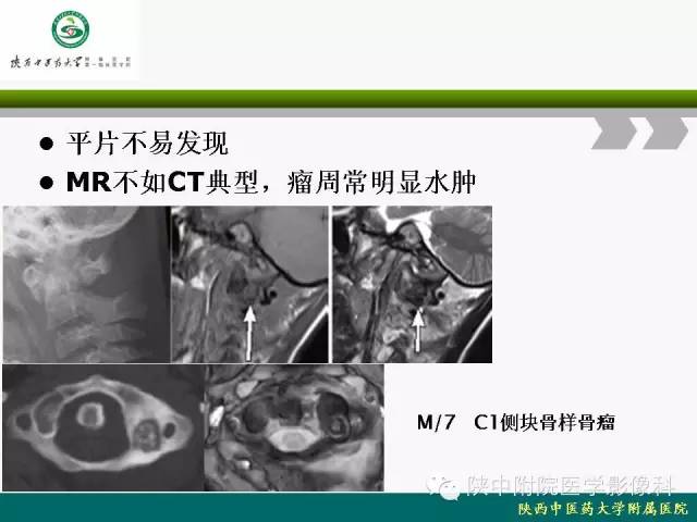 【PPT】脊柱肿瘤的影像学诊断
