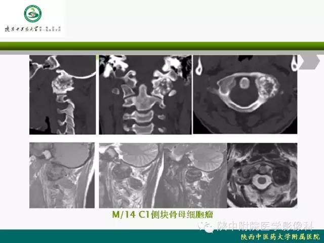 【PPT】脊柱肿瘤的影像学诊断