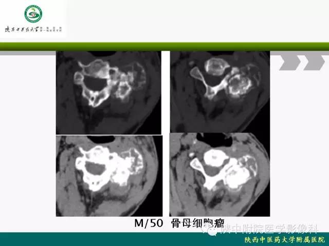【PPT】脊柱肿瘤的影像学诊断
