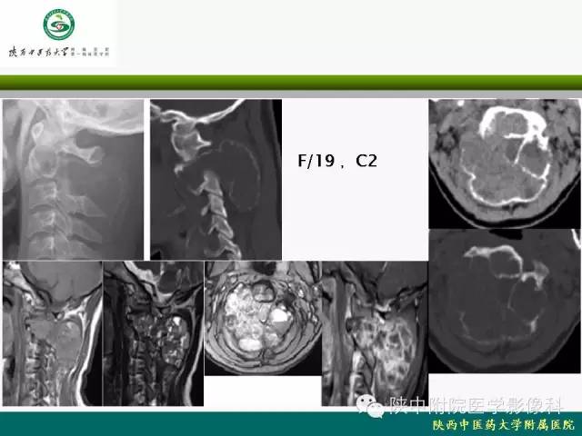 【PPT】脊柱肿瘤的影像学诊断