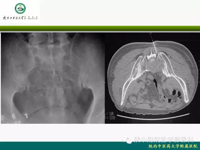 【PPT】脊柱肿瘤的影像学诊断