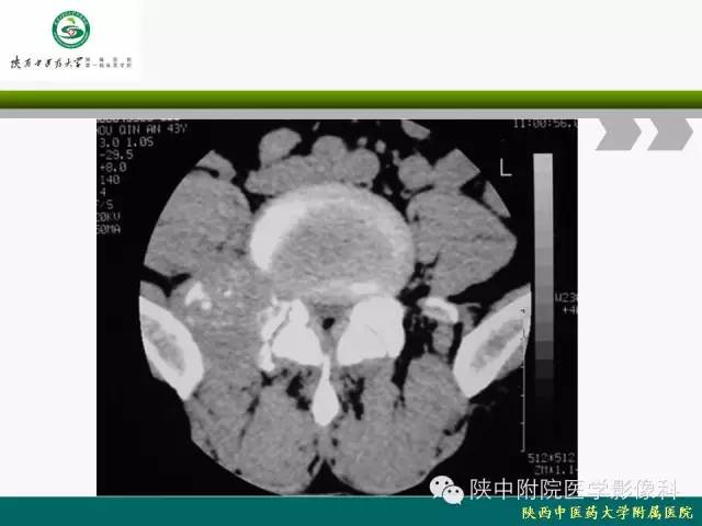 【PPT】脊柱肿瘤的影像学诊断