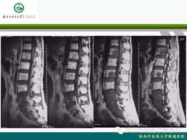 【PPT】脊柱肿瘤的影像学诊断