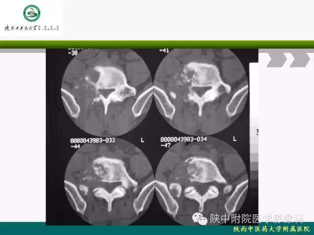 【PPT】脊柱肿瘤的影像学诊断