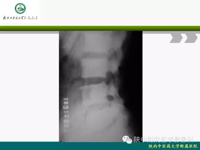 【PPT】脊柱肿瘤的影像学诊断