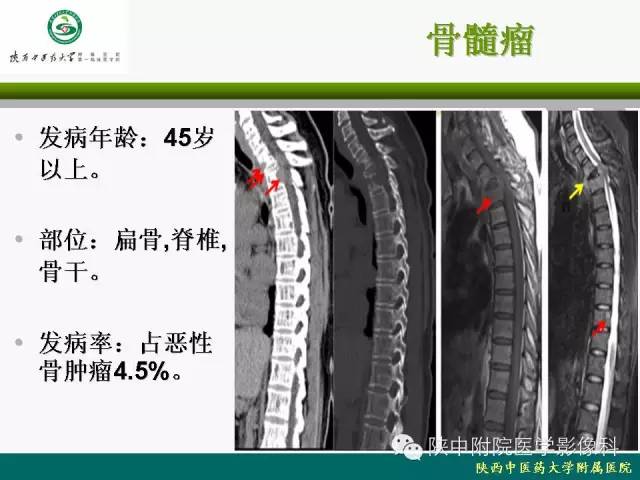 【PPT】脊柱肿瘤的影像学诊断