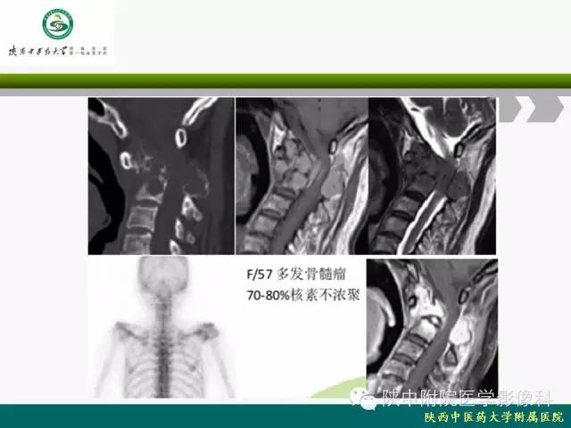 【PPT】脊柱肿瘤的影像学诊断
