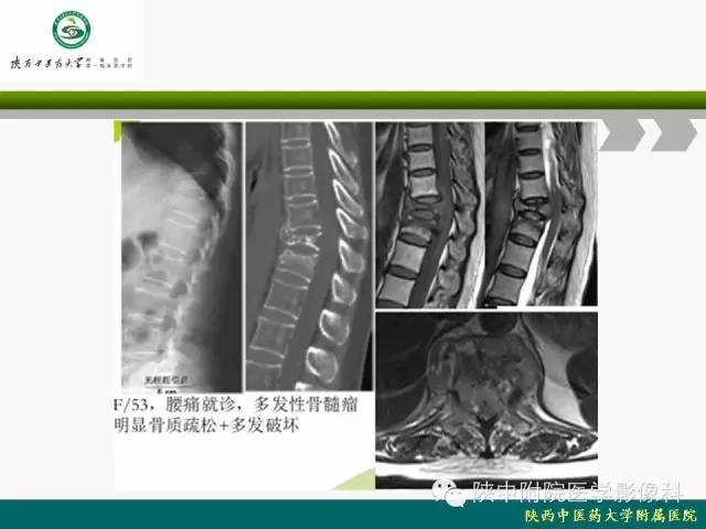 【PPT】脊柱肿瘤的影像学诊断