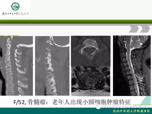 【PPT】脊柱肿瘤的影像学诊断