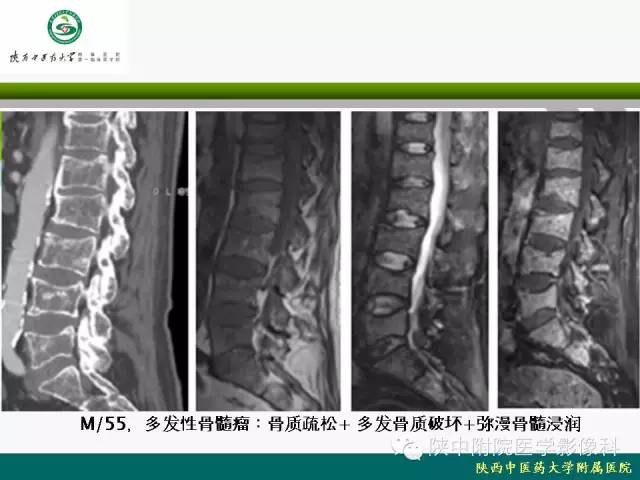 【PPT】脊柱肿瘤的影像学诊断