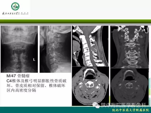 【PPT】脊柱肿瘤的影像学诊断