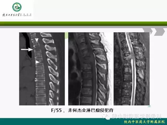 【PPT】脊柱肿瘤的影像学诊断