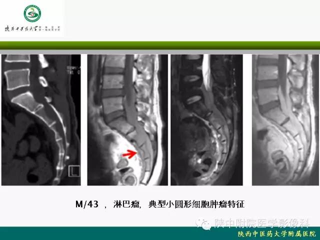 【PPT】脊柱肿瘤的影像学诊断