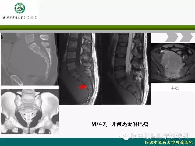 【PPT】脊柱肿瘤的影像学诊断