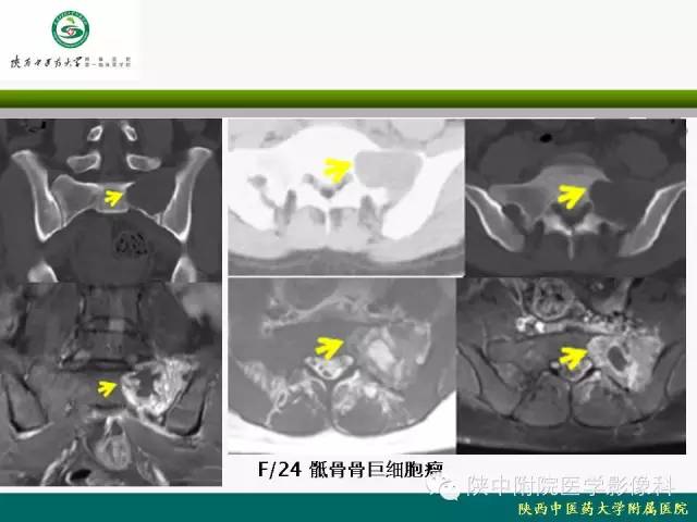 【PPT】脊柱肿瘤的影像学诊断