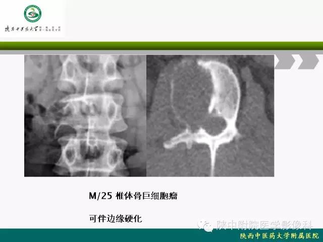【PPT】脊柱肿瘤的影像学诊断