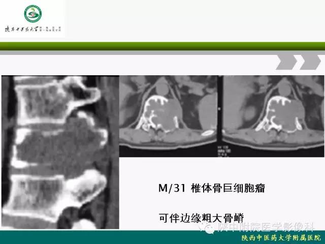 【PPT】脊柱肿瘤的影像学诊断