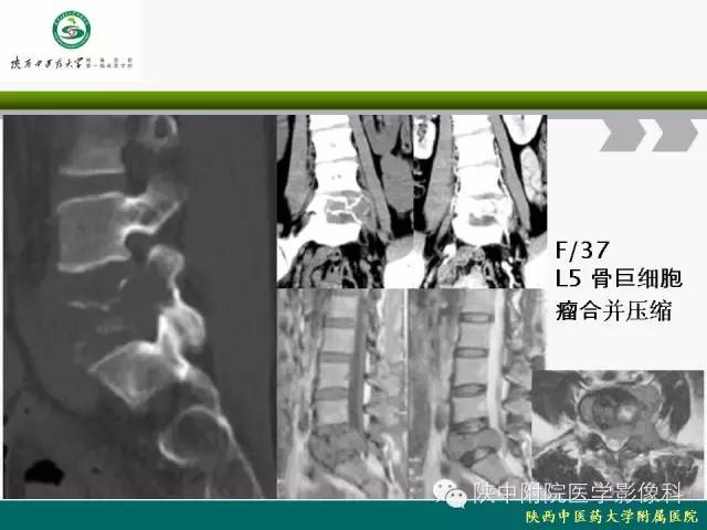 【PPT】脊柱肿瘤的影像学诊断
