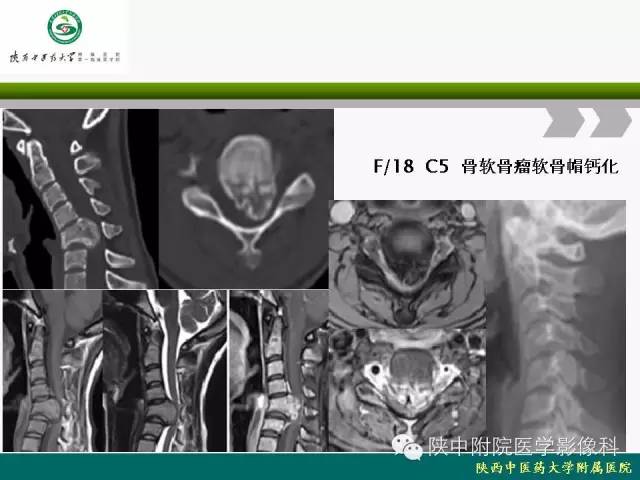 【PPT】脊柱肿瘤的影像学诊断