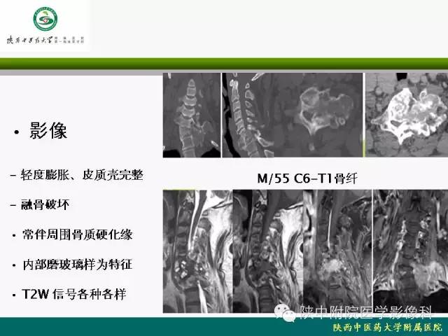 【PPT】脊柱肿瘤的影像学诊断