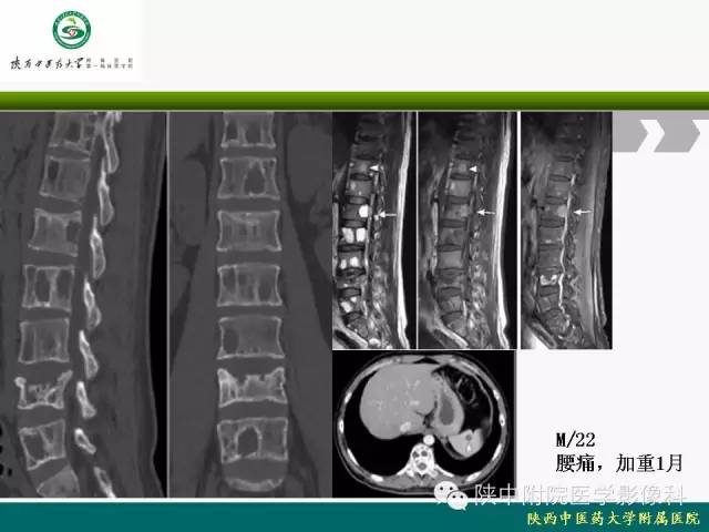 【PPT】脊柱肿瘤的影像学诊断