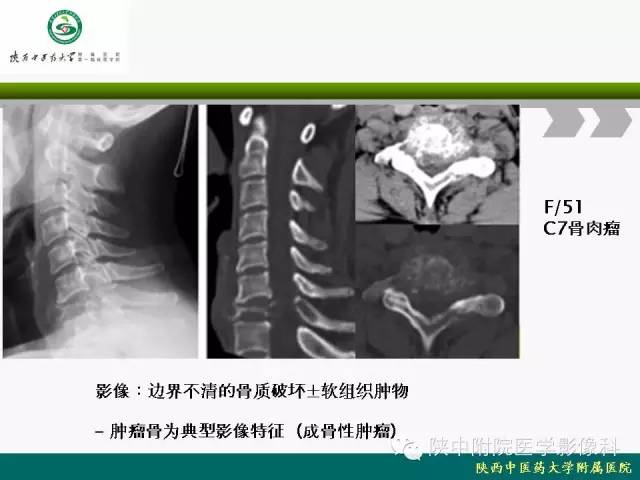 【PPT】脊柱肿瘤的影像学诊断