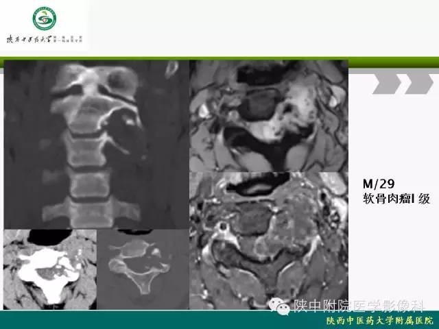 【PPT】脊柱肿瘤的影像学诊断