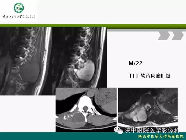 【PPT】脊柱肿瘤的影像学诊断