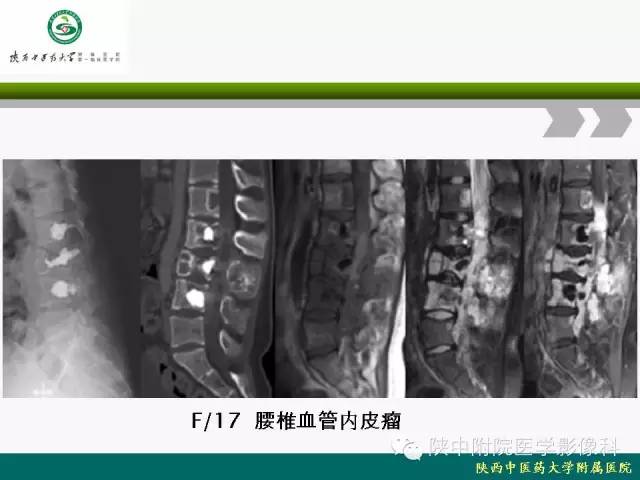 【PPT】脊柱肿瘤的影像学诊断