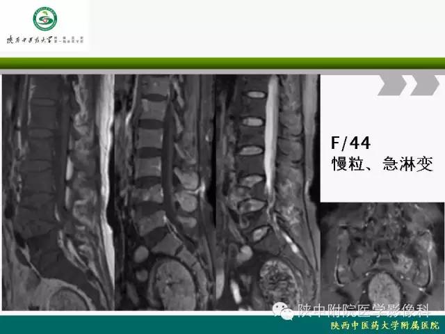 【PPT】脊柱肿瘤的影像学诊断
