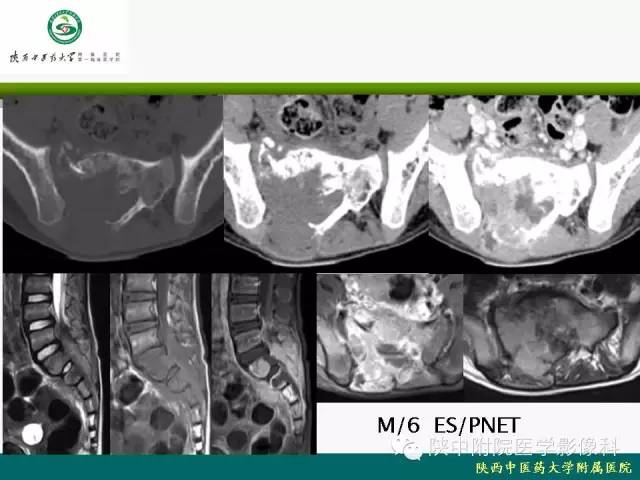 【PPT】脊柱肿瘤的影像学诊断