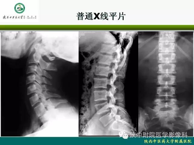 【PPT】脊柱肿瘤的影像学诊断