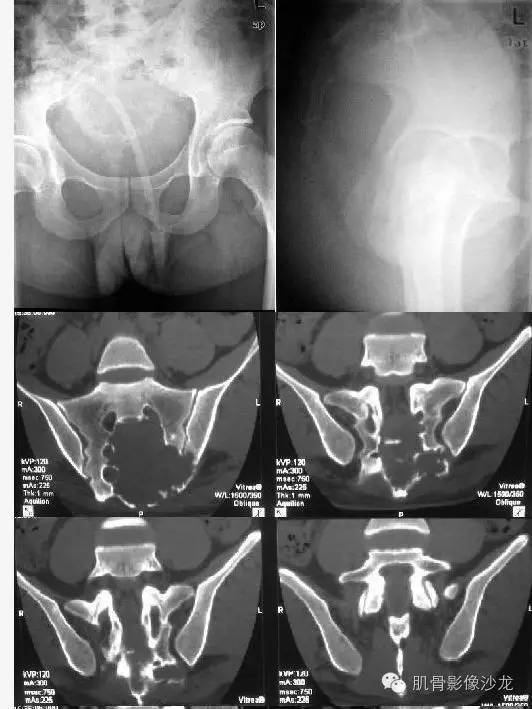 【病例】骶骨神经纤维瘤一例CT影像表现 【病例】骶骨神经纤维瘤一例CT影像表现