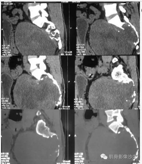 【病例】骶骨神经纤维瘤一例CT影像表现 【病例】骶骨神经纤维瘤一例CT影像表现