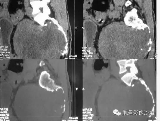 【病例】骶骨神经纤维瘤一例CT影像表现 【病例】骶骨神经纤维瘤一例CT影像表现