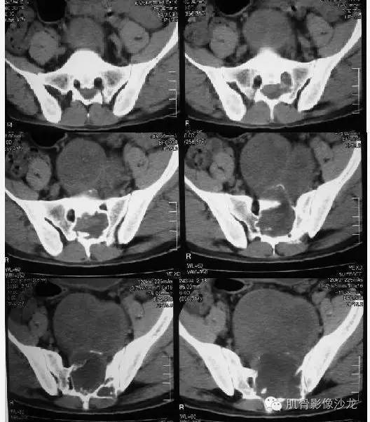 【病例】骶骨神经纤维瘤一例CT影像表现 【病例】骶骨神经纤维瘤一例CT影像表现