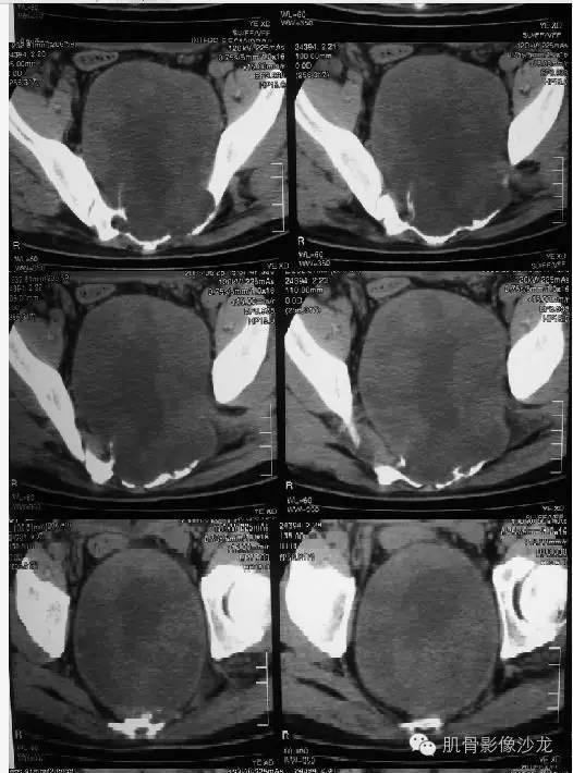 【病例】骶骨神经纤维瘤一例CT影像表现 【病例】骶骨神经纤维瘤一例CT影像表现